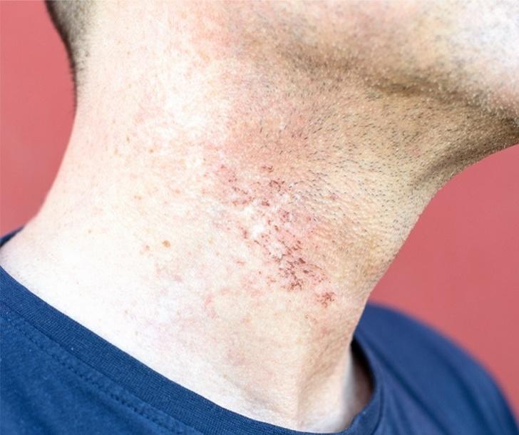 Natural Remedies for